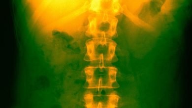 وأصيبت سكتة دماغية بالشلل في ذراعها.  دعها تستخدم هذا الزرع مرة أخرى