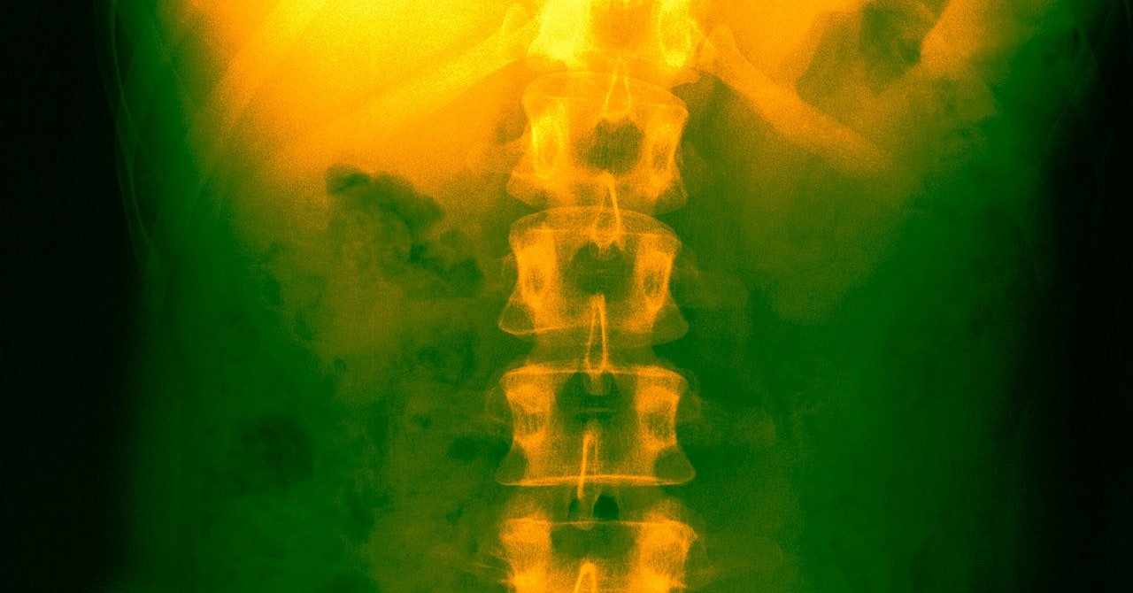 وأصيبت سكتة دماغية بالشلل في ذراعها.  دعها تستخدم هذا الزرع مرة أخرى